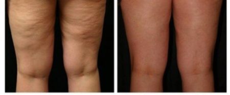 Islands Earth Cellulite, Varicose Veins & Circulation Support 5oz Oil & 120ml Powder Kit.